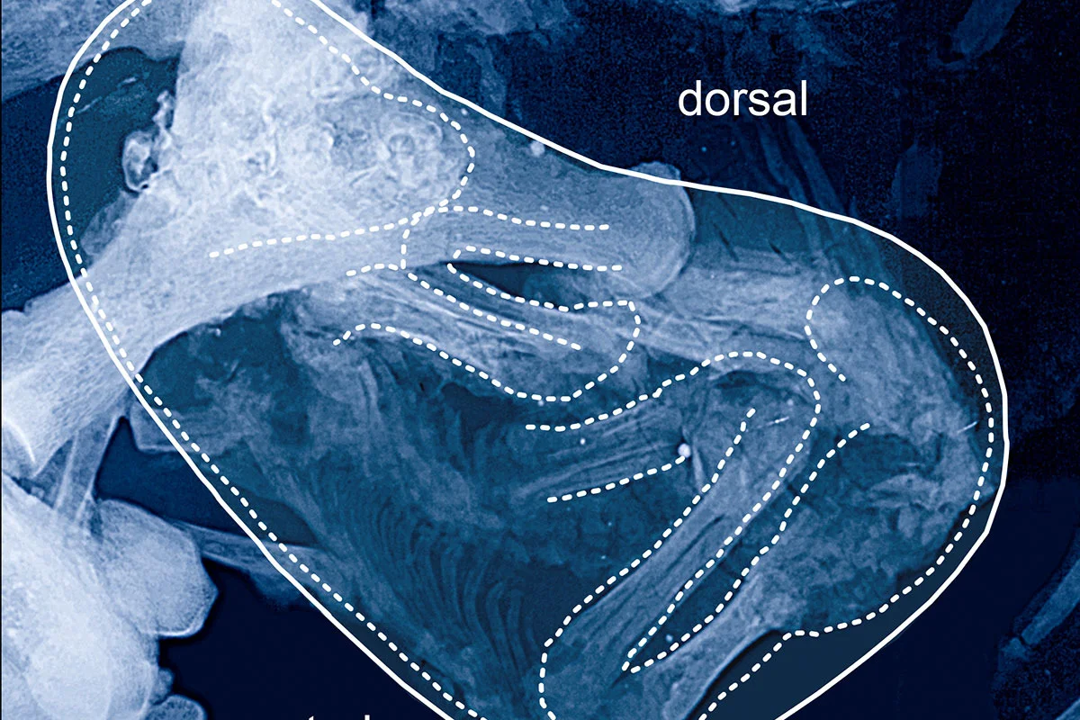 Reconstruction of original position of fetus